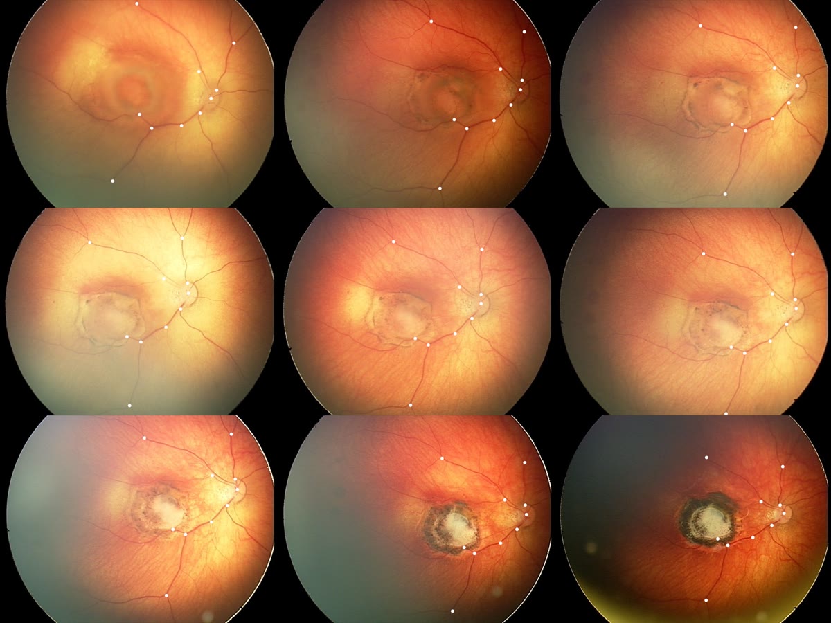 Fundus images from a COph100 patient across multiple examinations